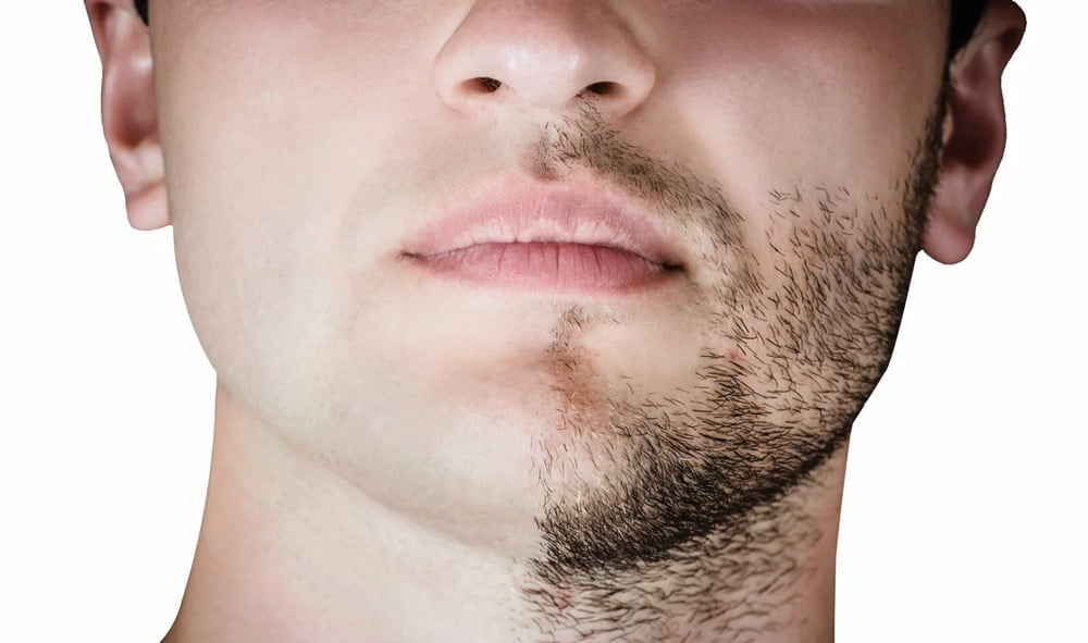 Barttransplantation 1 Beard Transplant Stages img