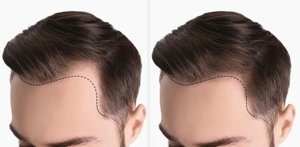 before after hair implant img