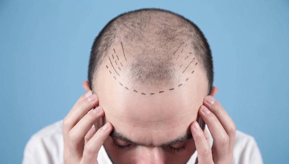 Haartransplantation 1 caucasian bald man before rhair transplantation img