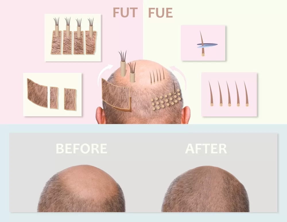 FUE-Haartransplantation 1 fue sac ekimi 2 img