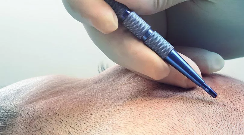 Saphir FUE Technik 1 safir fue sac ekmi img