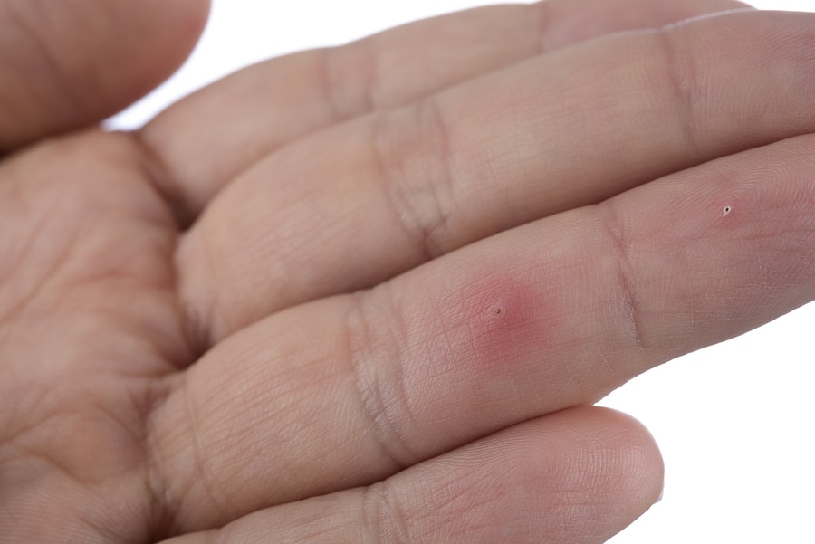 Ways to Remove a Splinter from the Body 1 November How To Remove A Splinter img